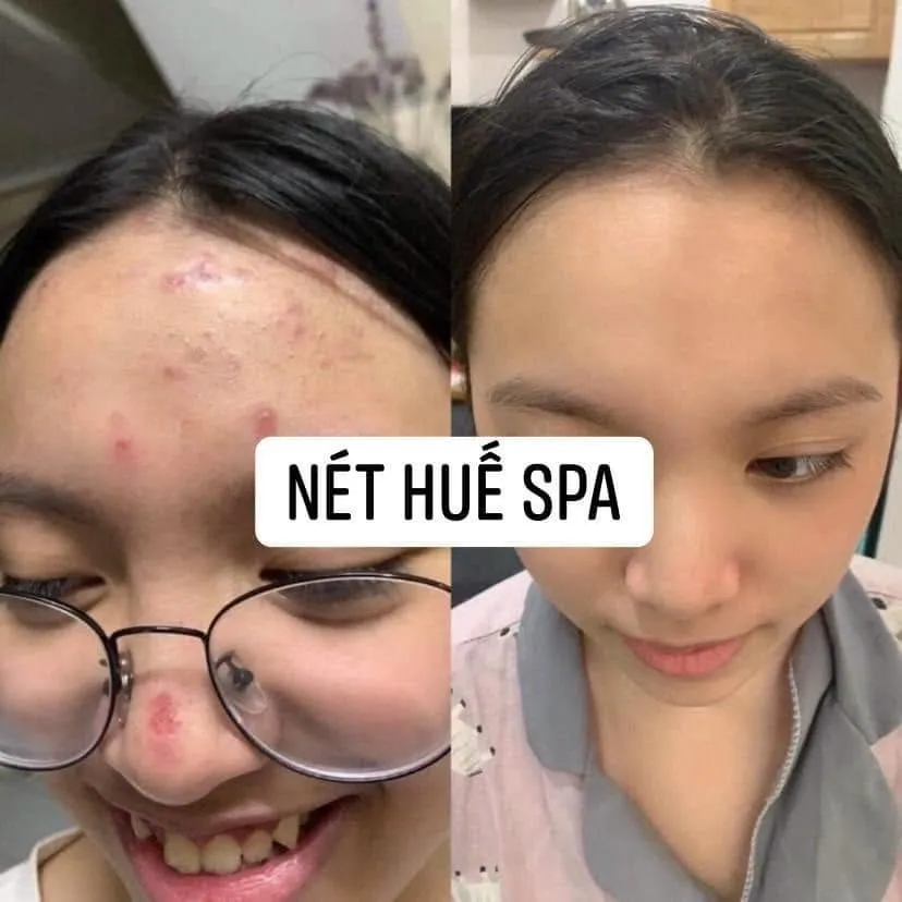 SPA NÉT HUẾ 3
